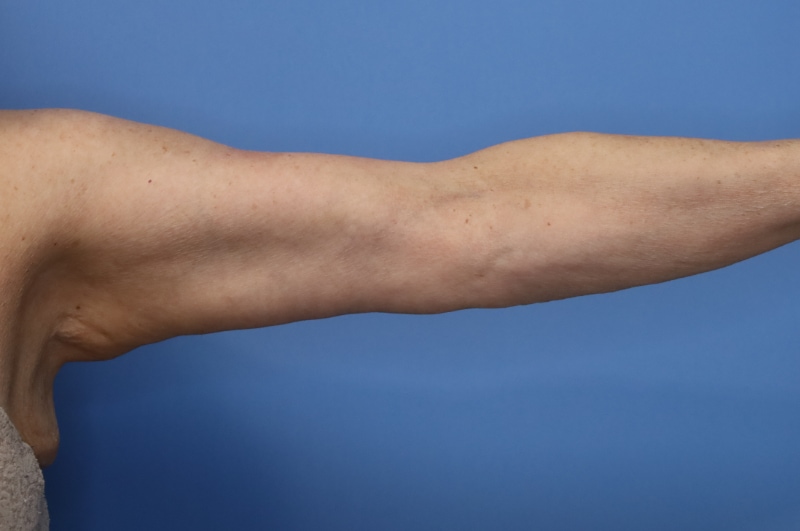 Arm Lift before and after - after