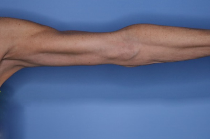Arm Lift before and after - after