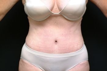 Tummy Tuck before and after - after