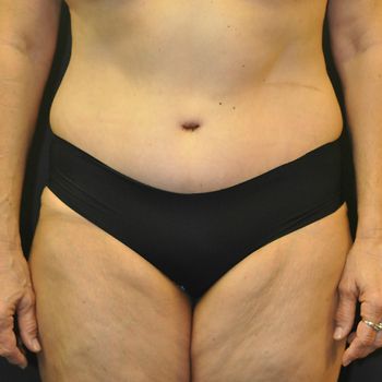 Tummy Tuck before and after - after