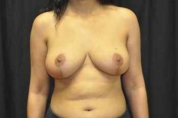 Breast Lift before and after - after