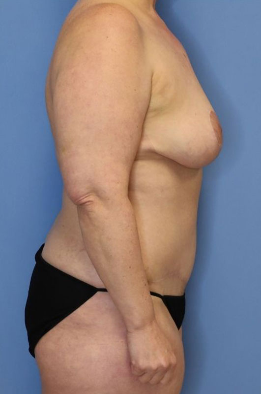 Mommy Makeover before and after - after