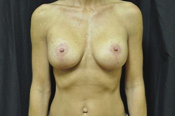 Breast Lift before and after - after