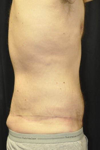 Tummy Tuck before and after - after