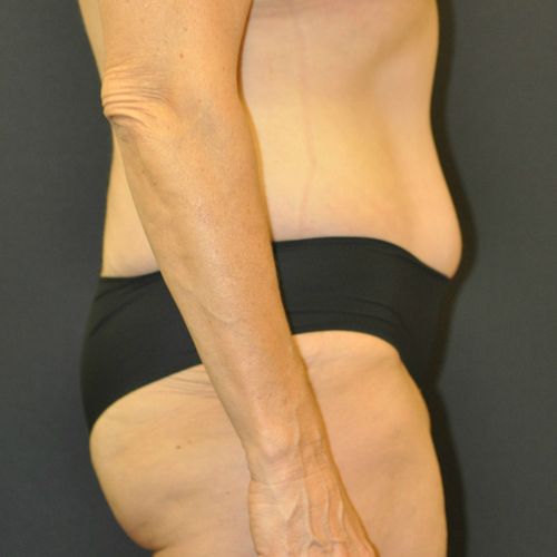 Tummy Tuck before and after - after