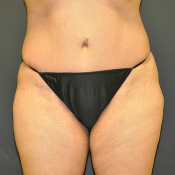 Tummy Tuck before and after - after