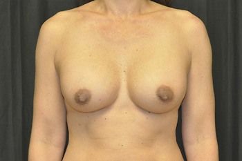 Breast Augmentation before and after - after