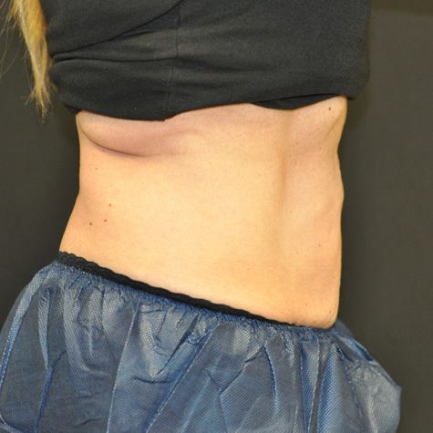 Procedure before and after - after