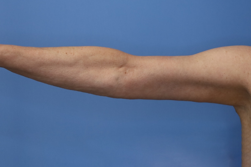 Arm Lift before and after - after