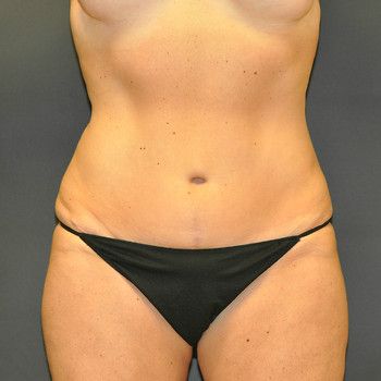 Tummy Tuck before and after - after