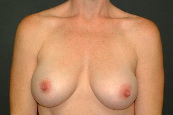 Breast Augmentation before and after - after