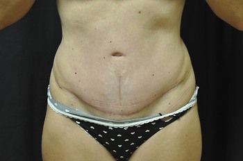 Tummy Tuck before and after - after