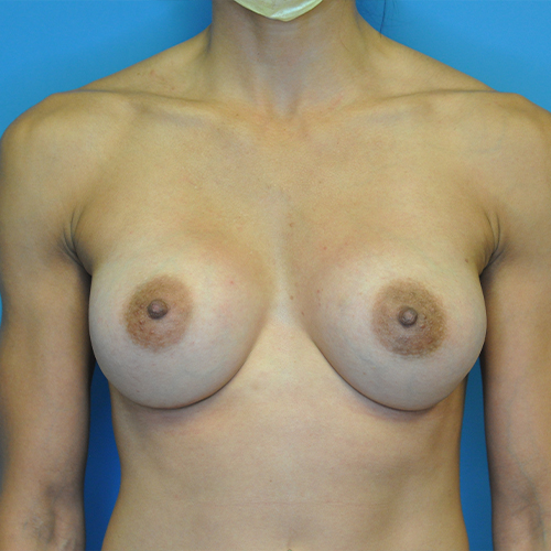 Breast Augmentation by Dr. Andrew Smith — after