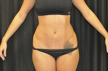Liposuction before and after - after