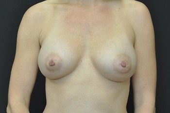Breast Augmentation before and after - after