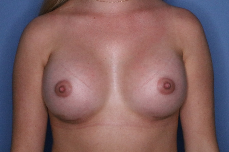 Breast Augmentation before and after - after