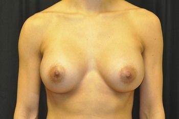 Breast Augmentation before and after - after
