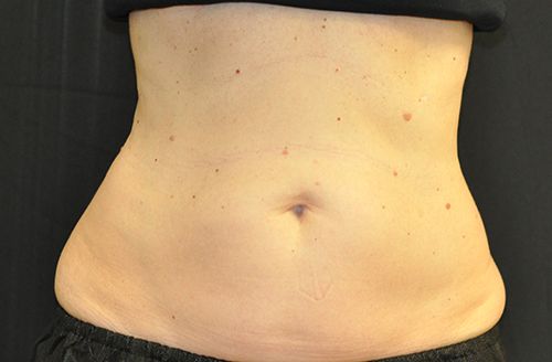 Procedure before and after - after