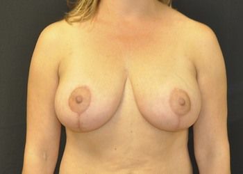 Breast Lift by Dr. Andrew Smith — after