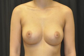 Breast Augmentation before and after - after