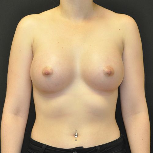 Breast Augmentation before and after - after