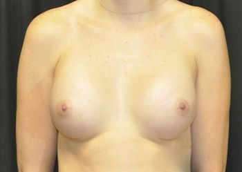 Breast Augmentation before and after - after