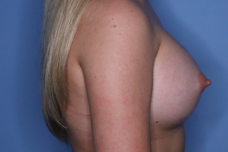 Breast Augmentation before and after - after