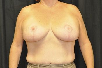 Breast Lift before and after - after