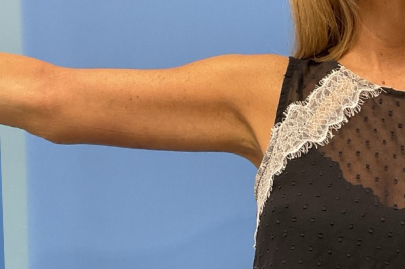 Arm Lift before and after - after