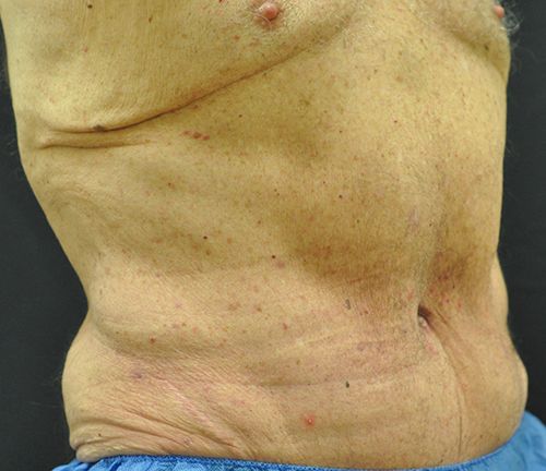 Tummy Tuck before and after - after