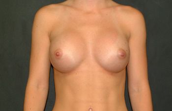 Breast Augmentation before and after - after