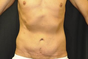 Tummy Tuck before and after - after