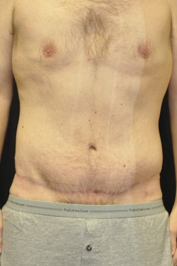 Tummy Tuck before and after - after
