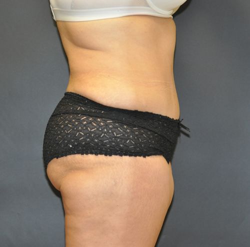 Tummy Tuck before and after - after