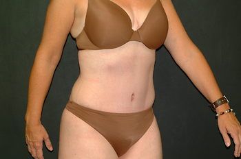 Tummy Tuck before and after - after