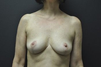 Breast Lift before and after - after