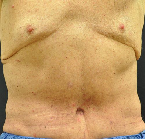 Tummy Tuck before and after - after