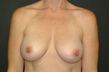Breast Augmentation before and after - after