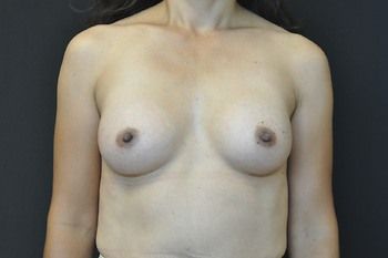 Breast Augmentation before and after - after