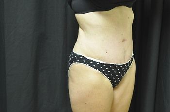 Tummy Tuck before and after - after