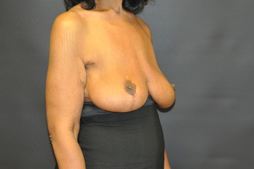 Breast Lift before and after - after