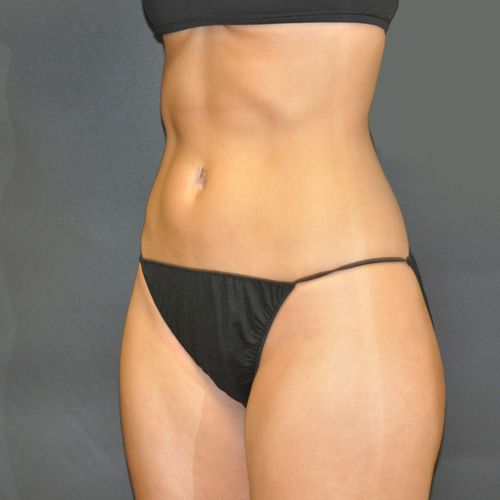 Procedure before and after - after