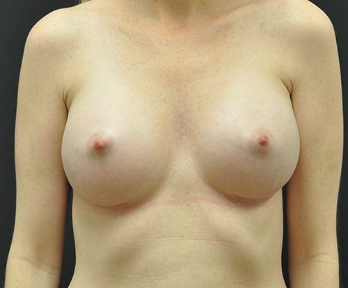 Breast Augmentation before and after - after