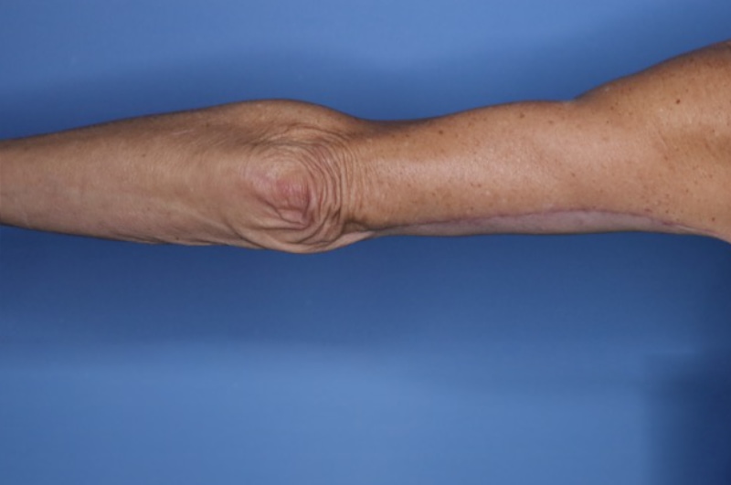 Arm Lift before and after - after