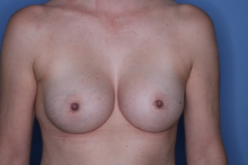 Breast Augmentation before and after - after