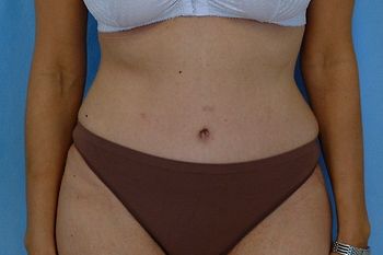 Tummy Tuck before and after - after