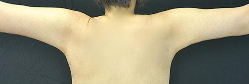 Procedure before and after - after