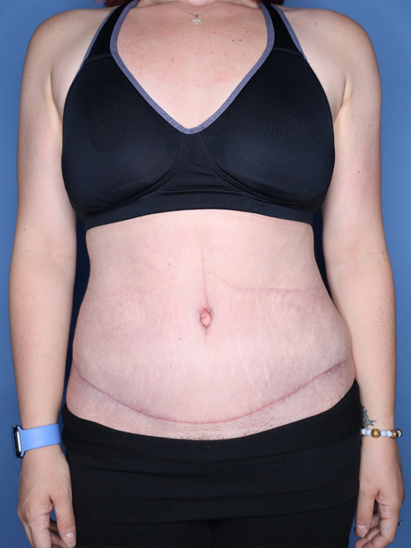 Tummy Tuck before and after - after