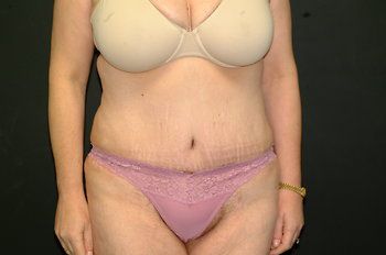 Procedure before and after - after