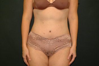 Tummy Tuck before and after - after